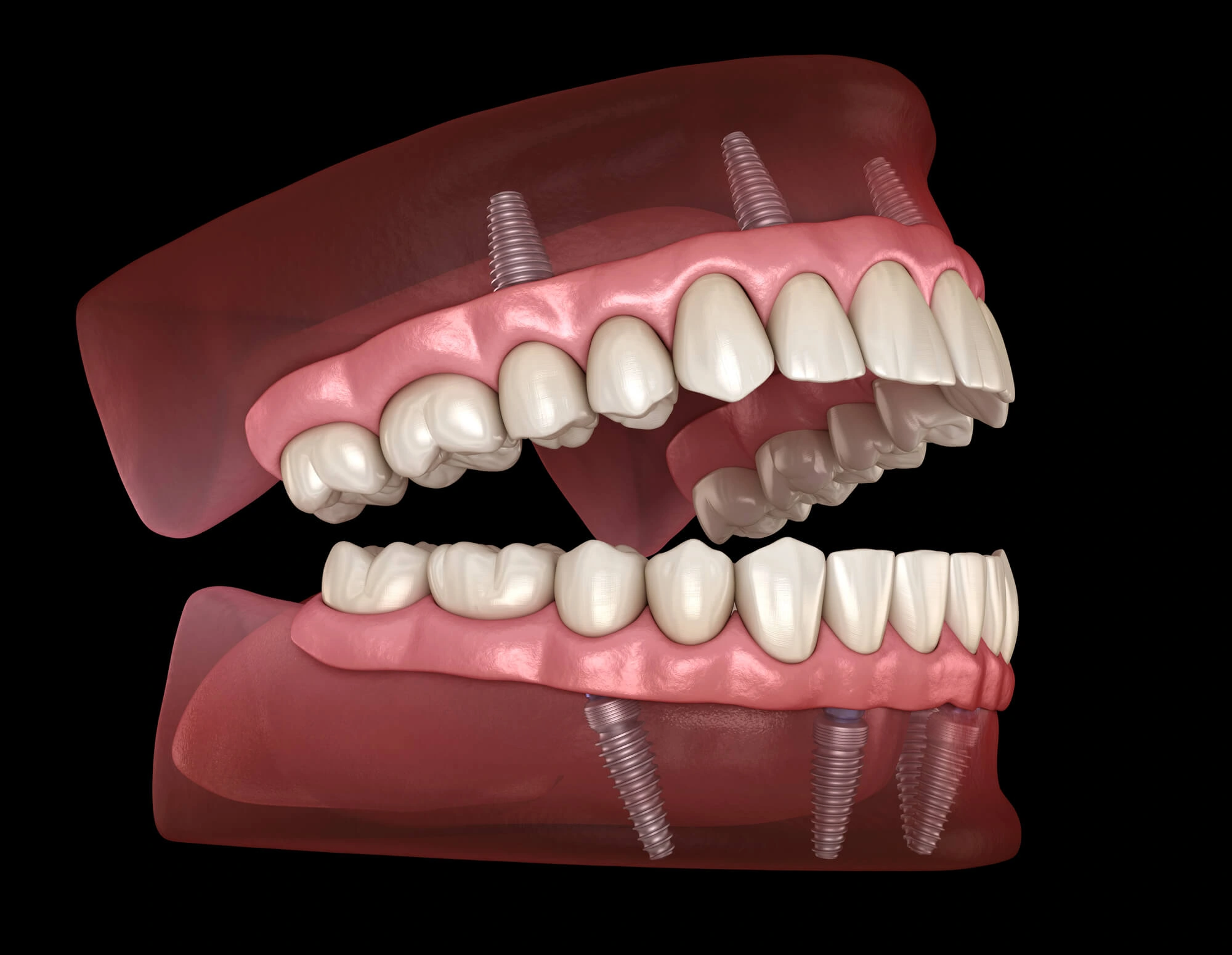 A-picture-of-all-on-4-dental-implants-palm-beach-gardens.