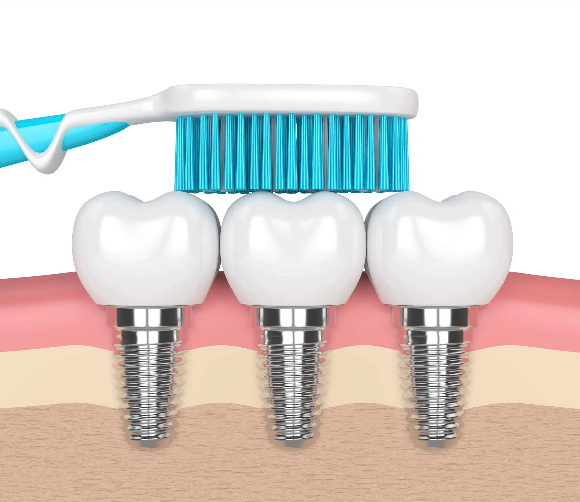 Brushing dental implants palm beach gardens