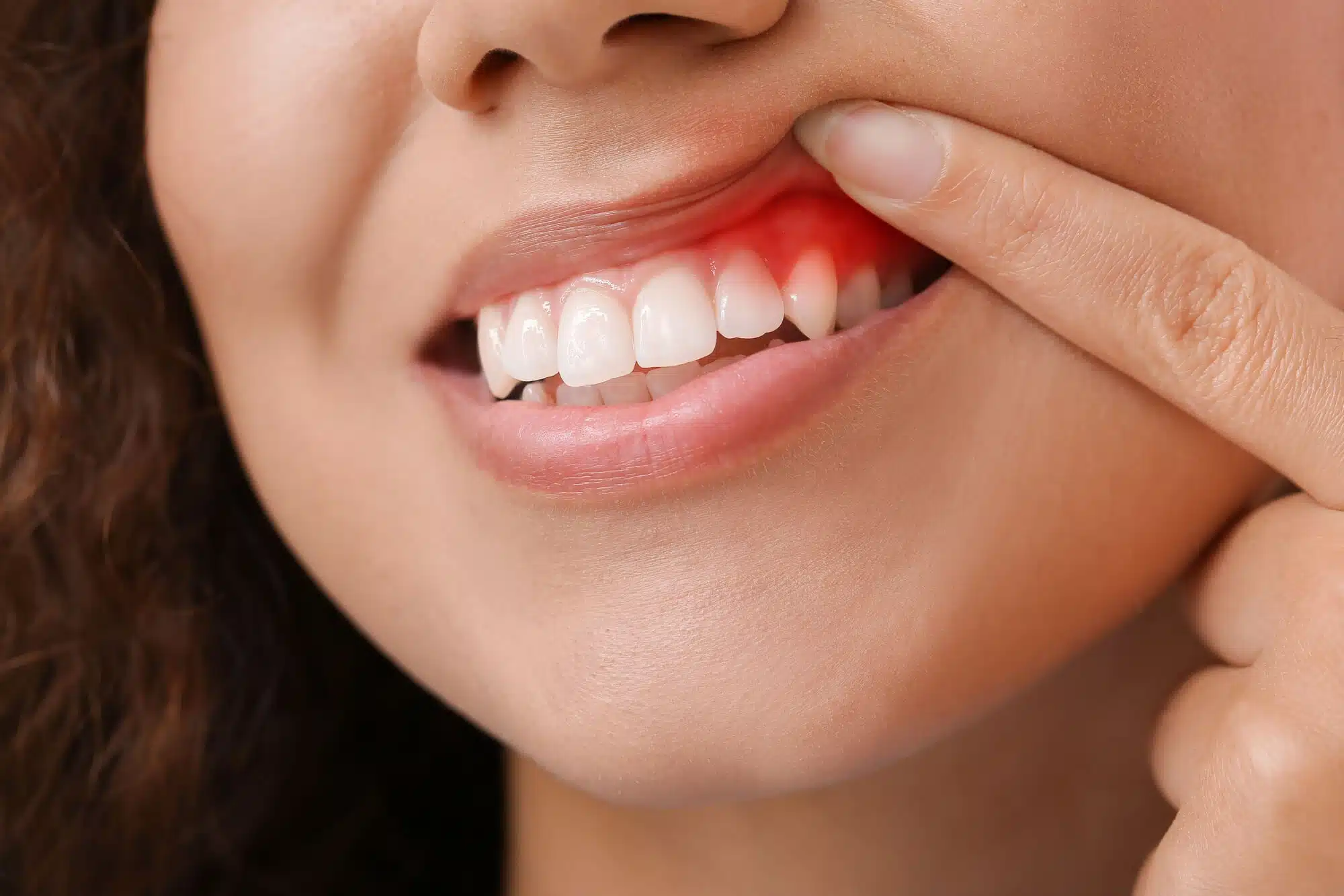 Swollen gums needs gum disease treatment palm beach gardens