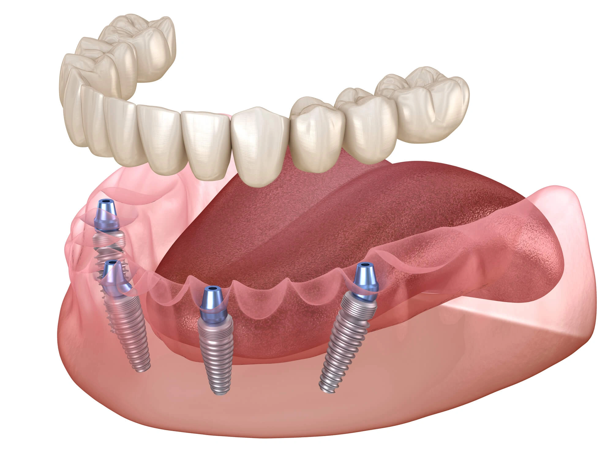 all on 4 dental implants palm beach gardens