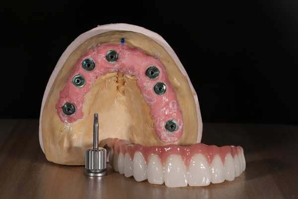 Understanding Bone Grafting: How It Restores Jawbone Health And Strength