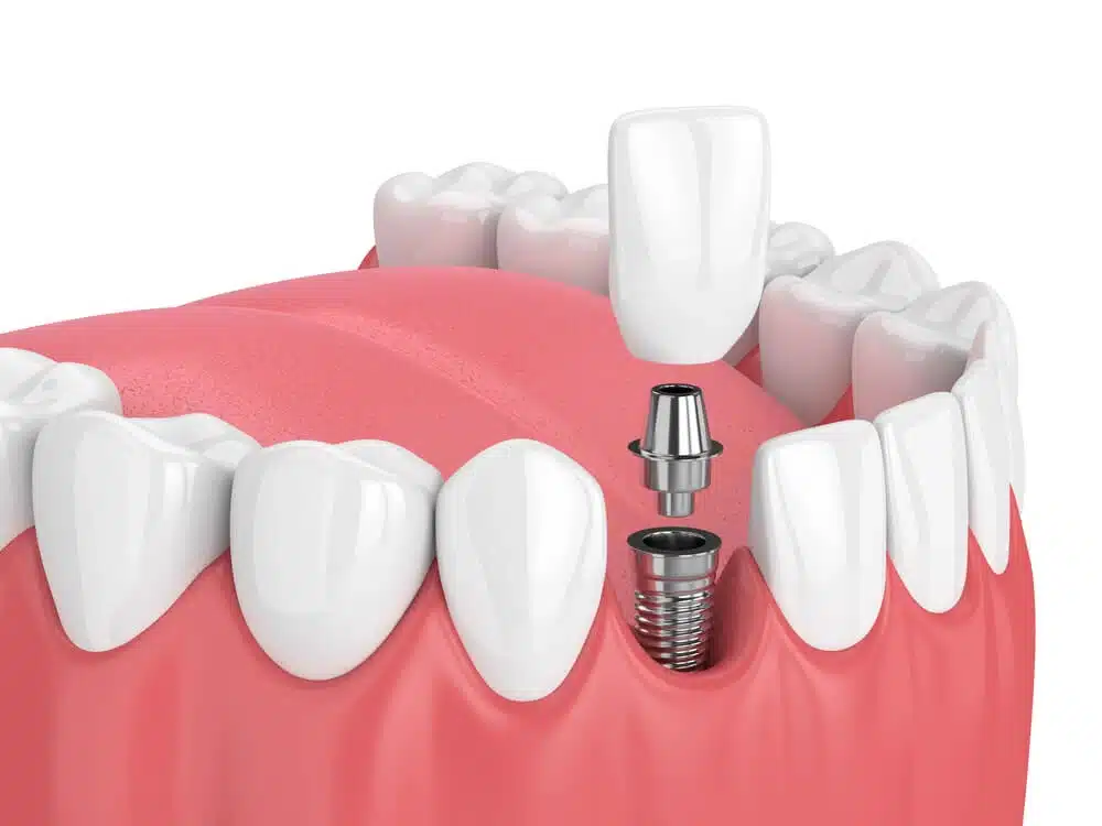 dental implant surgery palm beach gardens illustration