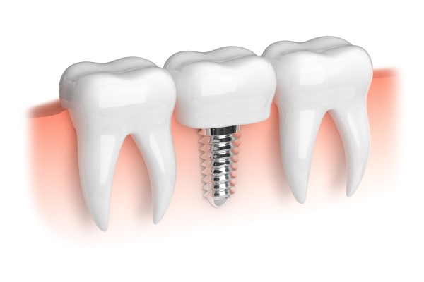 Can A Dental Implant Be Replaced If Osseointegration Does Not Occur?