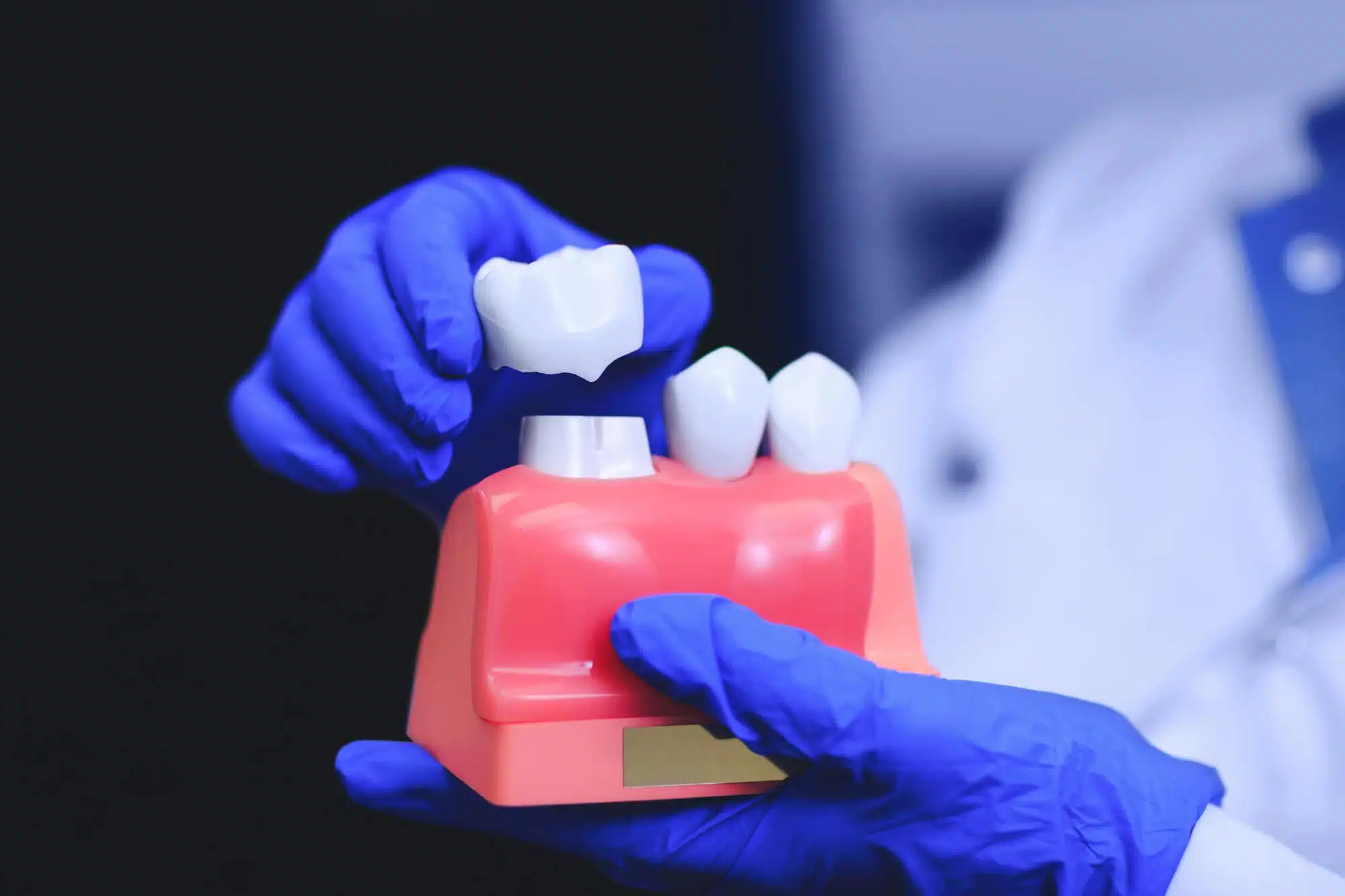 How To Care For Dental Implants For Long Term Success
