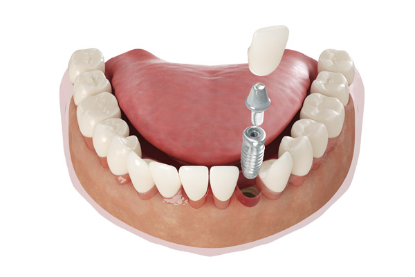Dental Implants: What A Dentist Wants You To Know