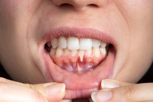 When To Visit A Periodontist For Gum Recession