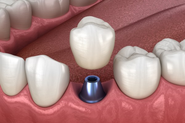 Ask An Implant Periodontist About Implants, Gum Tissue And Jawbone