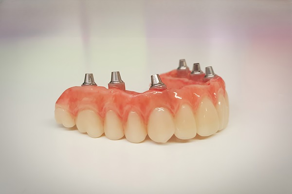 Why Choose Implant Supported Dentures? Top Benefits Explained