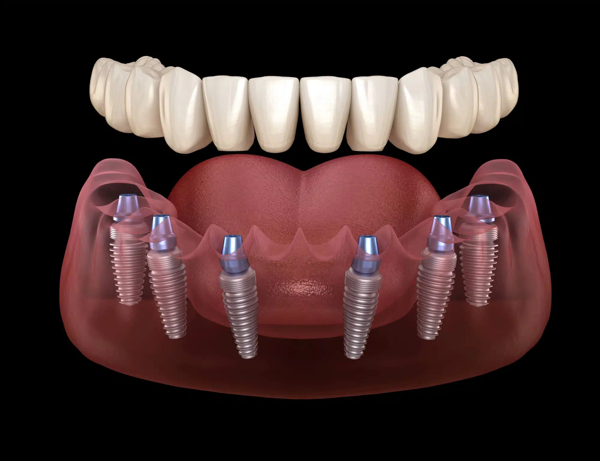 implant supported dentures palm beach gardens 3D Illustration