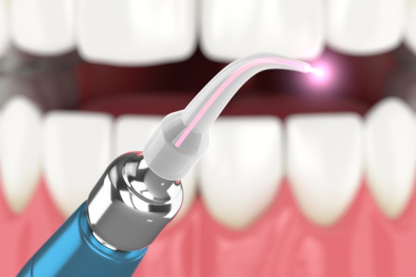 How LAPIP Is Used For Dental Implants