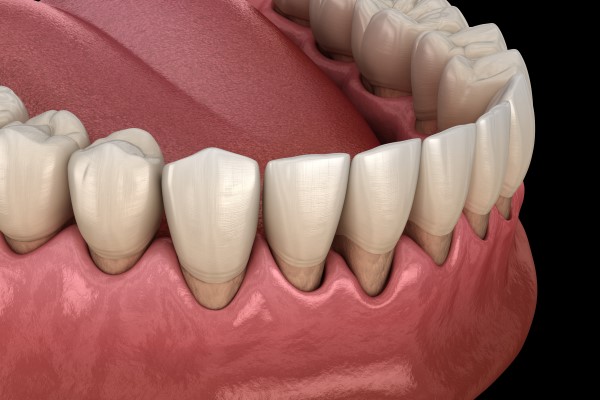 How A Gingivectomy Procedure By A Periodontist Can Help Treat Gum Disease