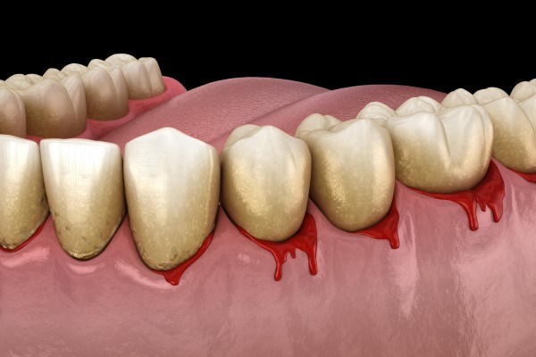 When To See A Periodontist