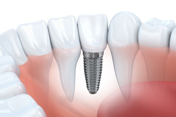 Advantages Of Getting A Single Tooth Implant