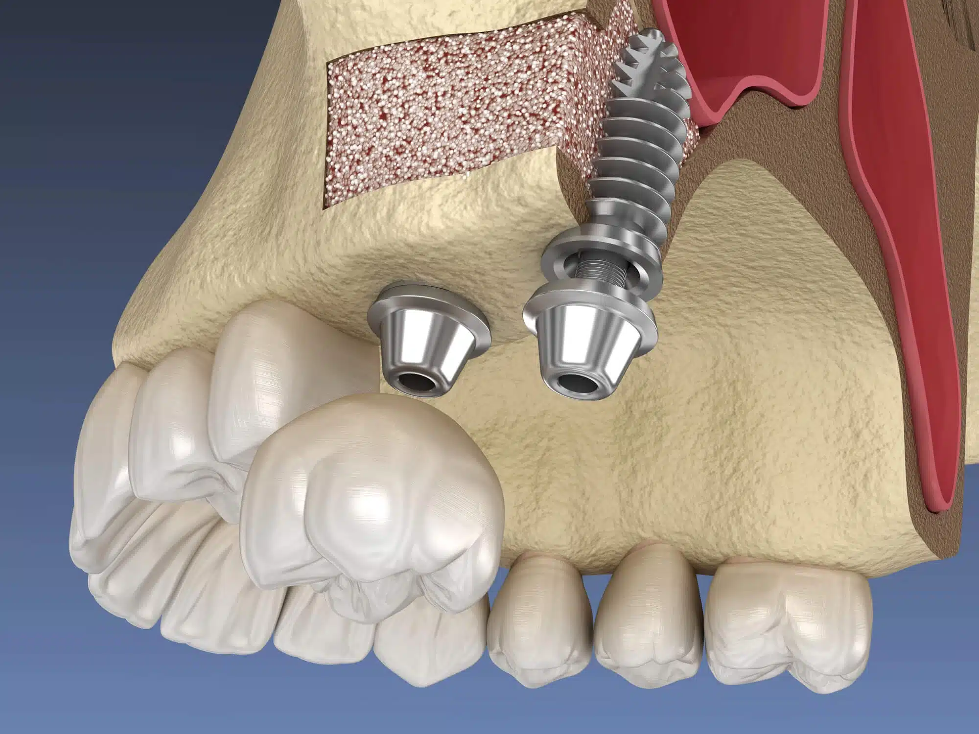 sinus lift palm beach gardens 3D illustration