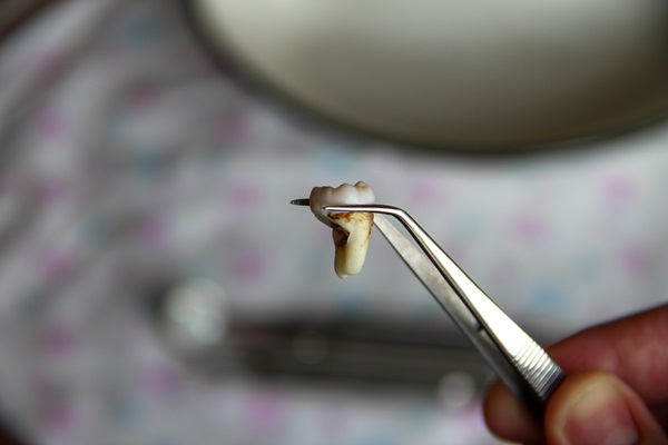 When Tooth Extraction Is Necessary: Your Guide