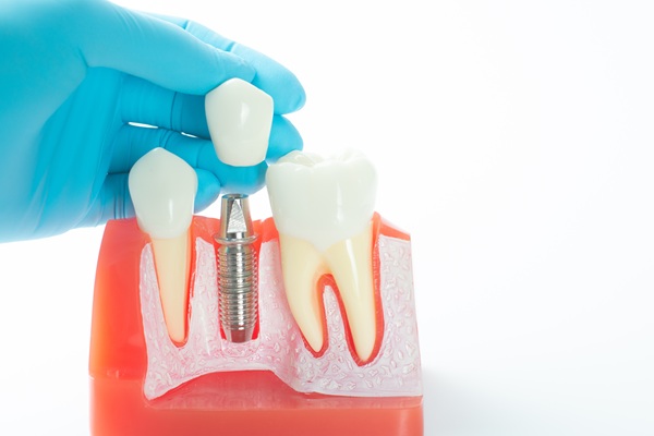 How Tooth Replacement Enhances Oral Health And Confidence